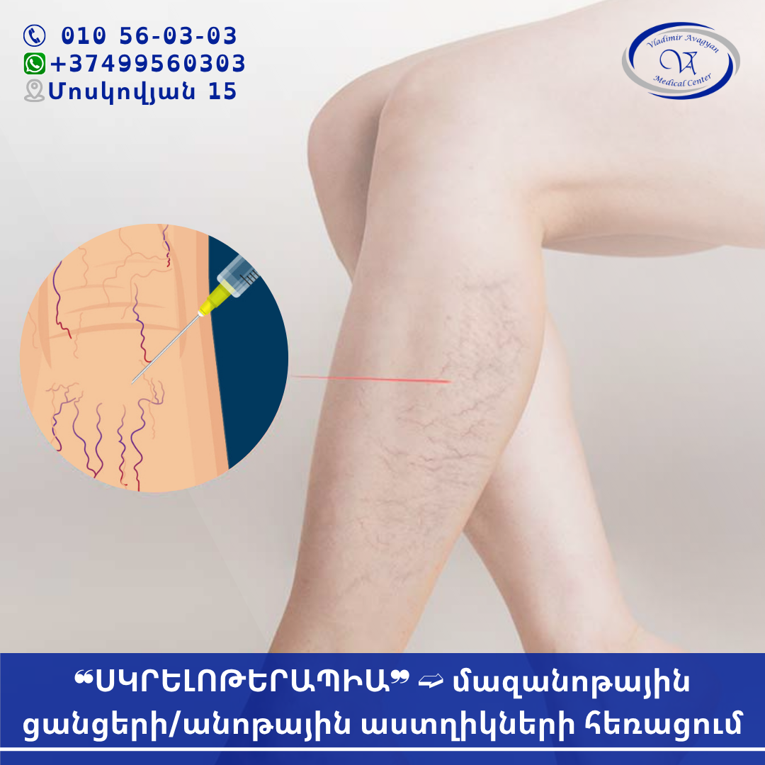 ՍԿԼԵՐՈԹԵՐԱՊԻԱ