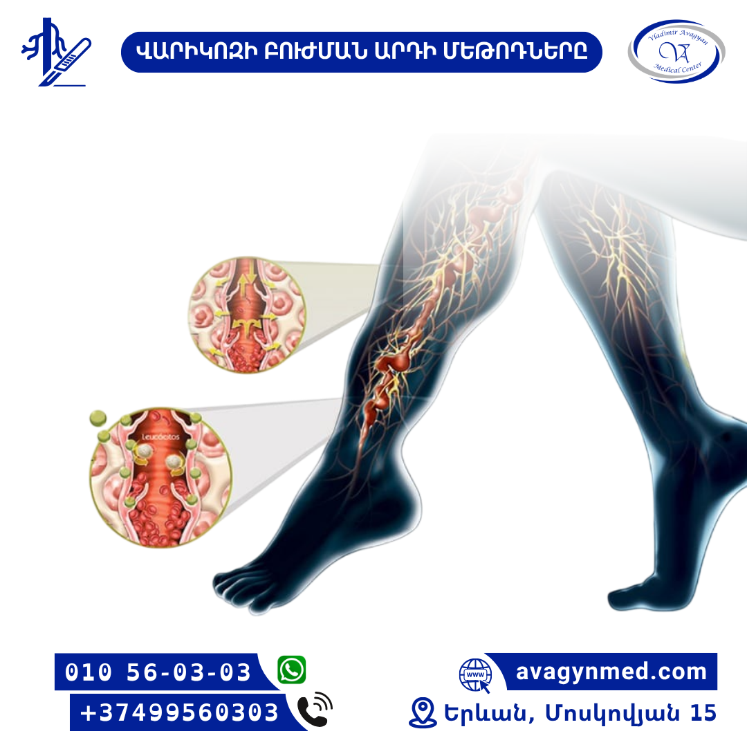 ՎԱՐԻԿՈԶԻ ԲՈՒԺՄԱՆ ԱՐԴԻ ՄԵԹՈԴՆԵՐԸ